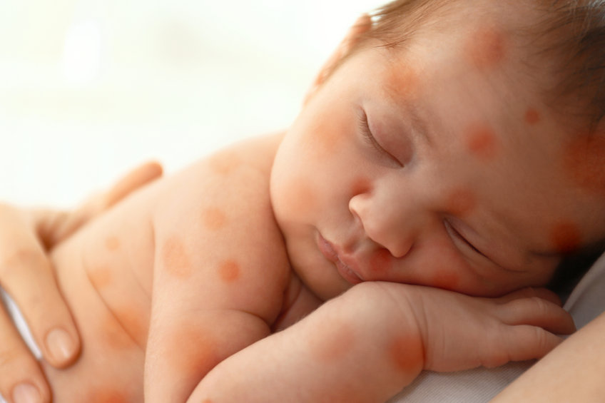 Comment reconnaître et traiter une allergie alimentaire chez votre bébé ?